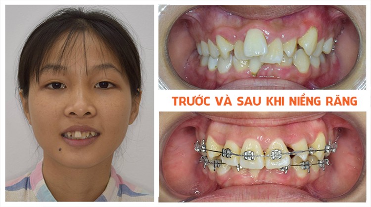 Niềng răng trả góp Nha khoa Up Dental khách hàng Bích Phương