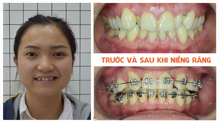Niềng răng uy tín tại Hồ Chí Minh Up Dental khách hàng Nguyễn Minh