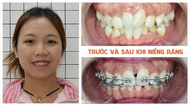 Review hiệu quả rõ rệt khi niềng răng lệch lạc tại Up Dental