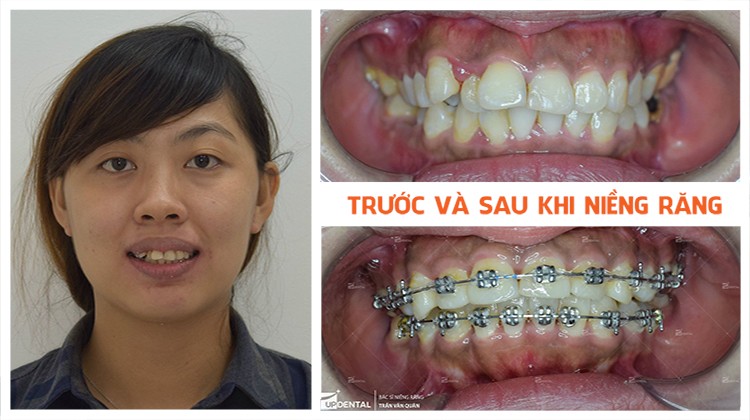 Review Up Dental khách hàng Cẩm Vi niềng răng 13 tháng