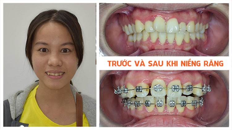 Review kết quả niềng răng lệch lạc sau 9 tháng tại Up Dental