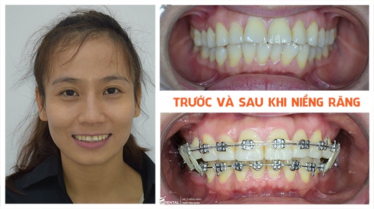Những lý do nên chọn niềng răng tại Nha khoa Up Dental