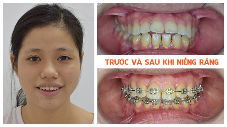 Tổng hợp các tiêu chí chuẩn để lựa chọn nha khoa niềng răng tốt