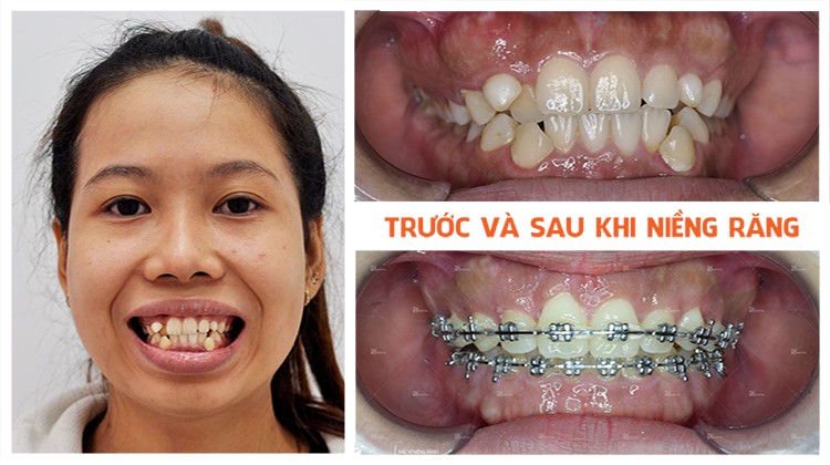 Chia sẻ kinh nghiệm niềng răng của cô gái sắp tháo niềng