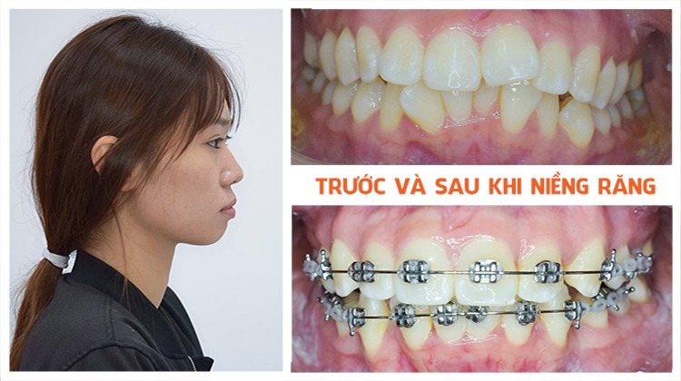 Phương pháp điều trị hiệu quả răng hô và mọc lệch