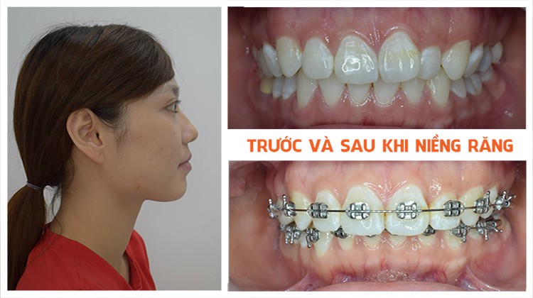 Điều hài lòng nhất trong quá trình niềng răng tại Up Dental