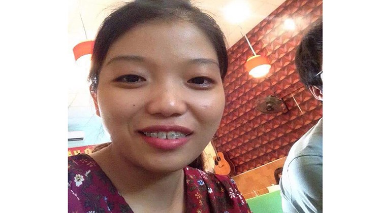 Kỷ niệm niềng răng kim loại và nhổ răng khi niềng