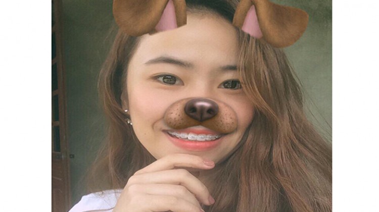 Chia sẻ kinh nghiệm: Niềng răng hô hàm trên