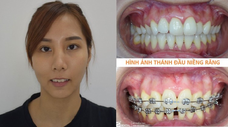 Điều trị răng hô, sai khớp cắn nhờ niềng răng