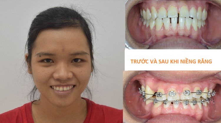 Niềng răng hô 2 hàm và cách chăm sóc răng khi niềng