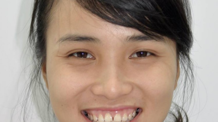 Những lợi ích tiềm ẩn của niềng răng khiến bạn sẽ không thể ngờ đến