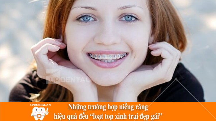 Những trường hợp niềng răng hiệu quả đều loạt top “trai xinh gái đẹp”