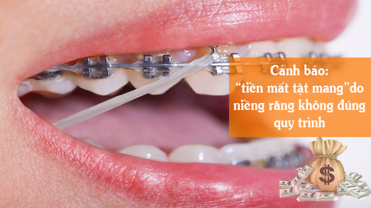 Quy trình niềng răng không đúng: Cảnh báo “Tiền mất tật mang”