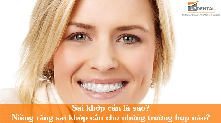 Các phương pháp niềng răng sai khớp cắn hiệu quả