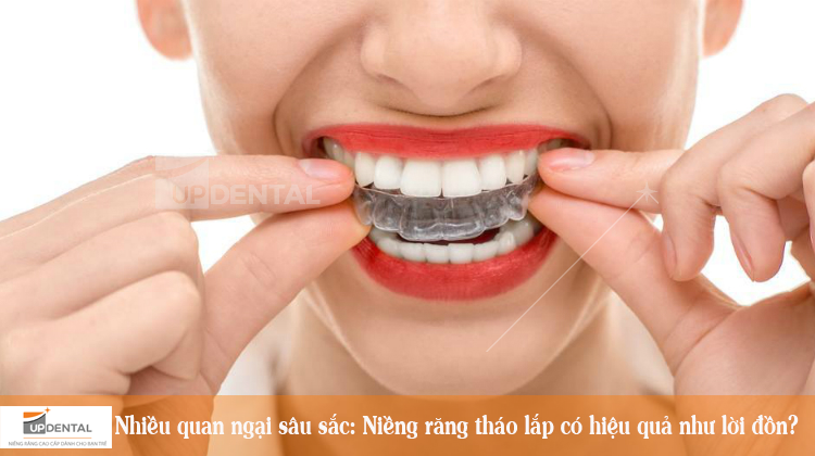 Nhiều quan ngại sâu sắc: Niềng răng tháo lắp có hiệu quả như lời đồn?