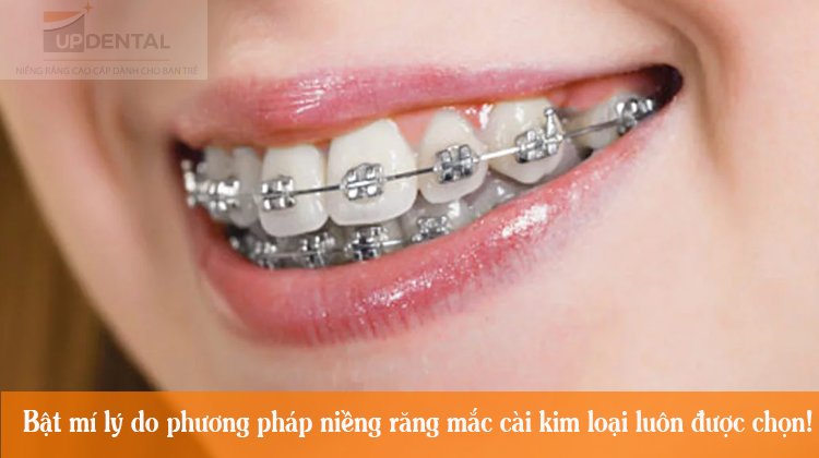 Bật mí lý do Phương pháp niềng răng mắc cài kim loại luôn được chọn!