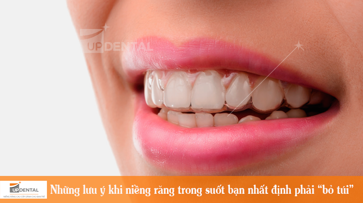 Niềng răng trong suốt: Một số lưu ý bạn nhất định phải “bỏ túi”