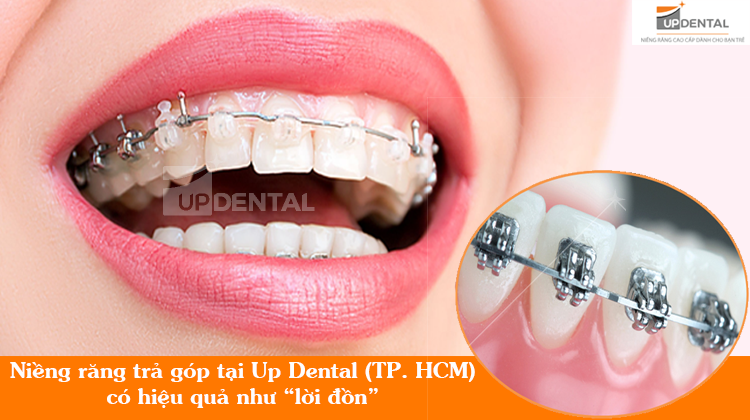 Niềng răng trả góp tại Up Dental có hiệu quả như lời đồn