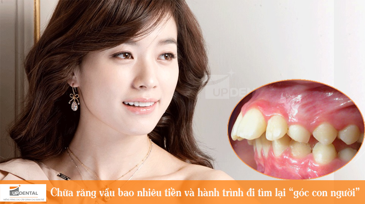 Chữa răng vẩu bao nhiêu tiền và hành trình đi tìm lại “góc con người”