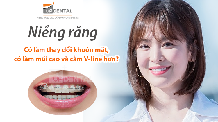 Niềng răng có làm thay đổi khuôn mặt?