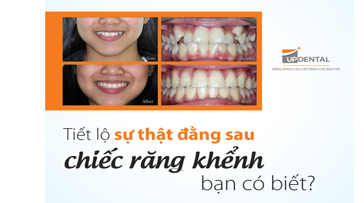 Răng khểnh đẹp hay xấu? Có nên niềng răng khểnh không?