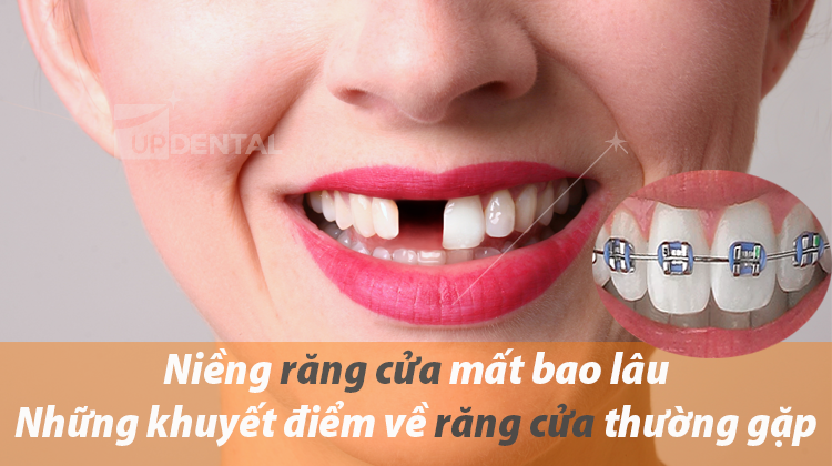 Niềng răng cửa mất bao lâu - Những khuyết điểm về răng cửa thường gặp