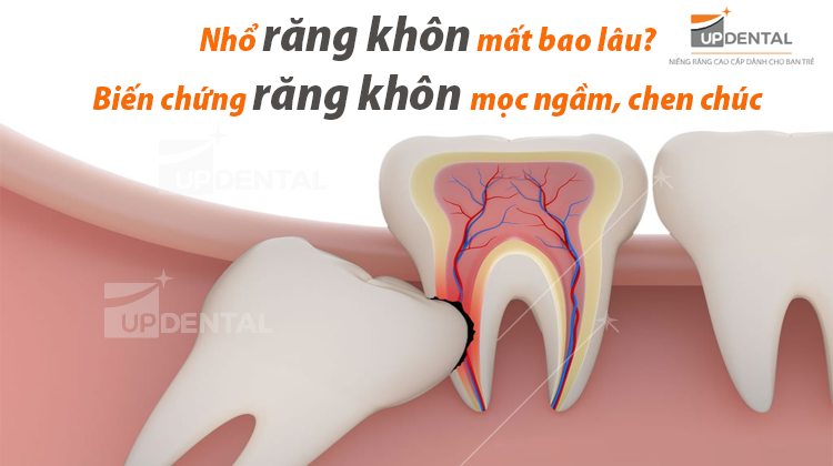 Nhổ răng khôn mất bao lâu? Biến chứng răng khôn mọc ngầm, chen chúc