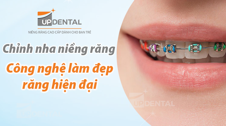 Chỉnh nha niềng răng - Ưu và hạn chế của niềng răng mắc cài kim loại