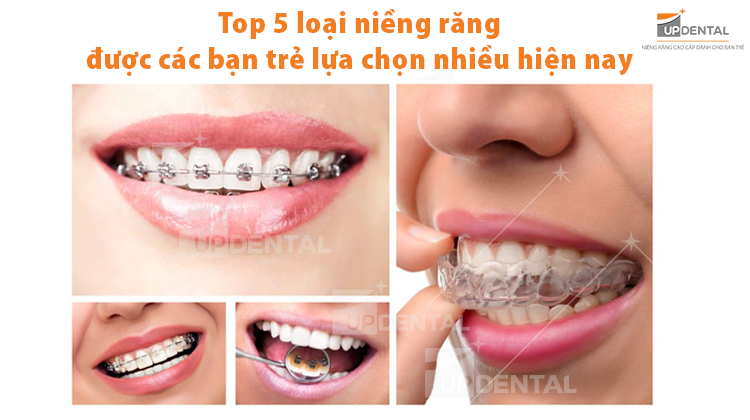Top 5 phương pháp niềng răng lựa chọn nhiều nhất