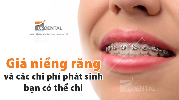 Giá niềng răng và các chi phí phát sinh bạn có thể chi