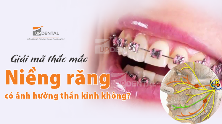 Giải mã thắc mắc niềng răng có ảnh hưởng đến thần kinh không?