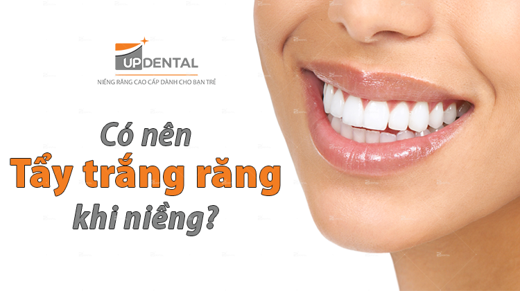 Tẩy trắng răng khi niềng răng và những lời khuyên từ Bác sĩ