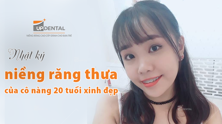 Nhật ký niềng răng thưa của cô nàng 20 tuổi xinh đẹp