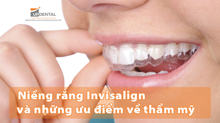 Niềng răng Invisalign là gì và những ưu điểm vốn có