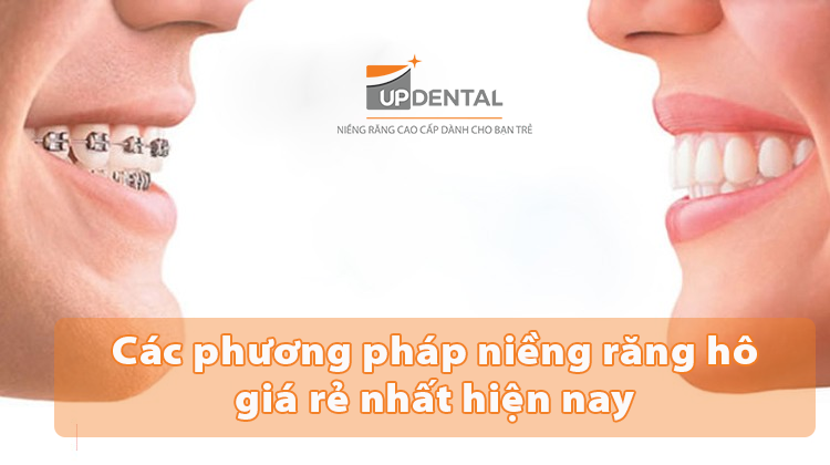 Các phương pháp niềng răng hô giá rẻ nhất hiện nay