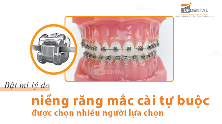 Niềng răng mắc cài tự buộc - Sự lựa chọn tối ưu bạn đã biết?