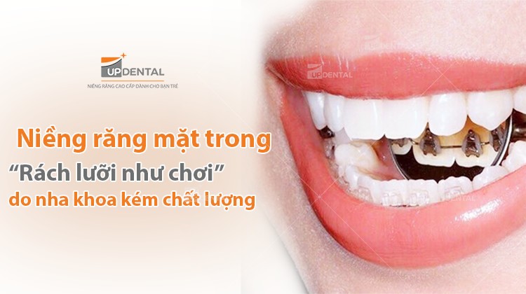 Niềng răng mặt trong: Cẩn thận rủi ro “Rách lưỡi như chơi”