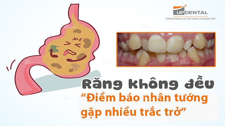 Răng mọc không đều, niềng răng có được không