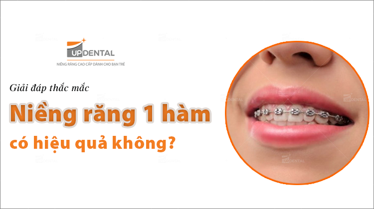Niềng răng một hàm có hiệu quả không?