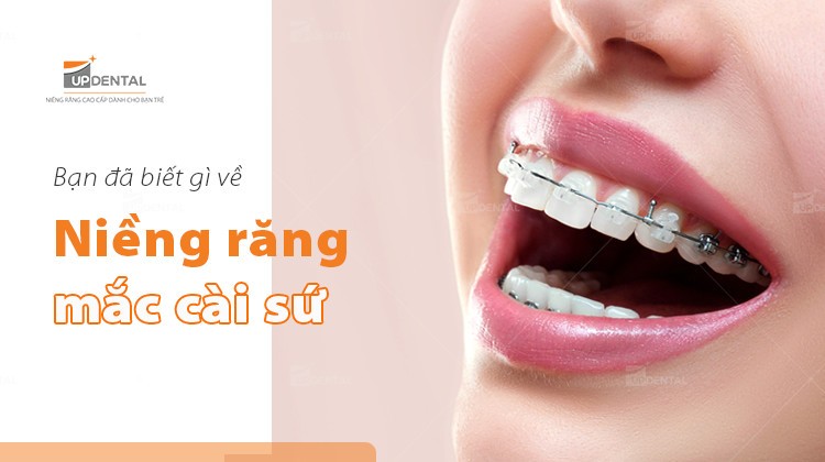 Niềng răng mắc cài sứ