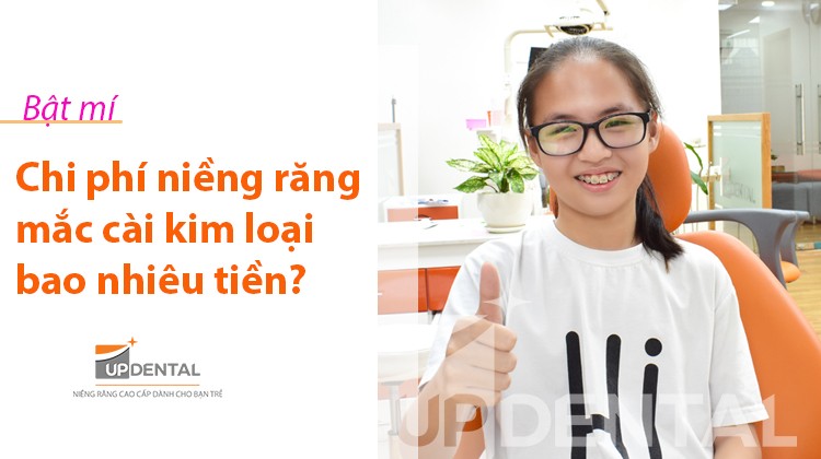 Năm 2020 niềng răng mắc cài kim loại giá bao nhiêu tiền?