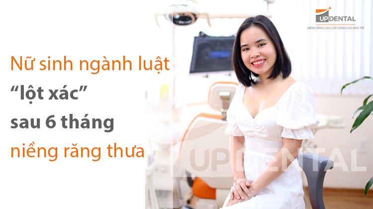 Nữ sinh ngành luật, “lột xác” sau 6 tháng niềng răng thưa