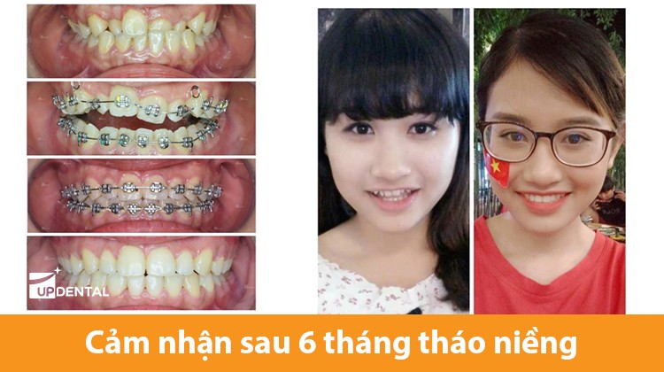 Cảm nhận sau 6 tháng tháo niềng răng - Team bác Quân