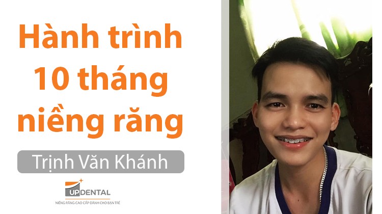 11 điều cần biết khi niềng răng mắc cài kim loại