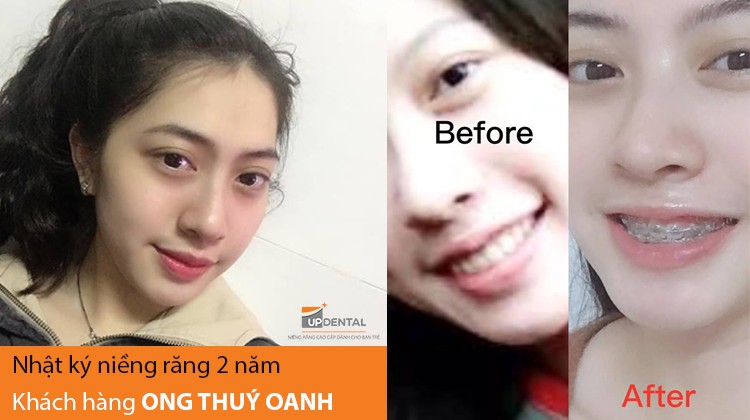Giải đáp thắc mắc bọc răng sứ có niềng răng được không?