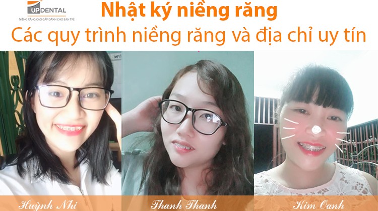 Bật mí quy trình niềng răng ở nha khoa uy tín Up Dental - Huỳnh Nhi, Thanh Thanh, Kim Oanh