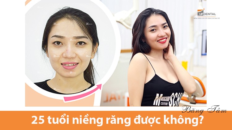 Kinh nghiệm niềng răng của cô nàng xinh đẹp Băng Tâm