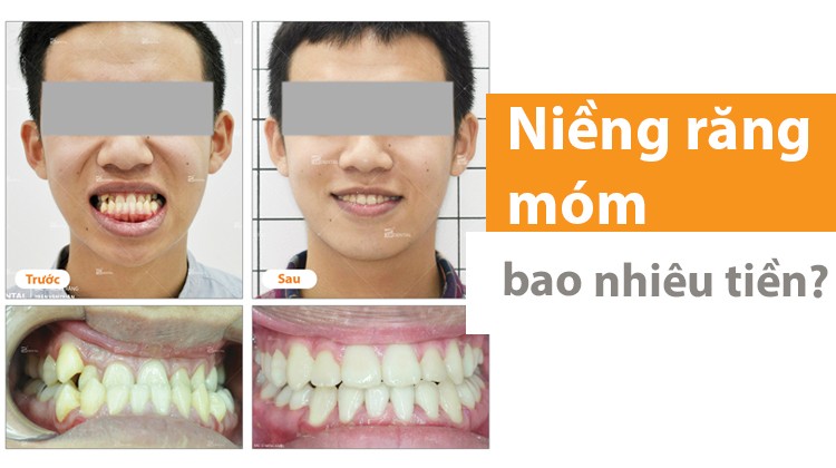 Giá niềng răng móm bao nhiêu tiền [năm 2024]