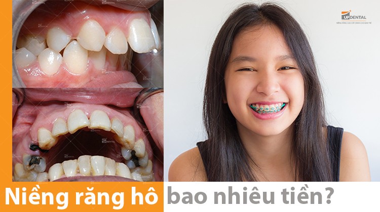 Giá niềng răng hô bao nhiêu tiền [năm 2024]