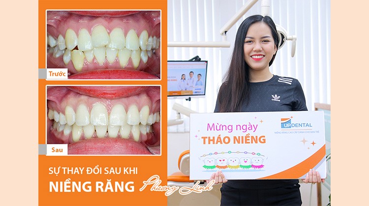 Review niềng răng mắc cài sứ có tốt không? Khách hàng Phương Linh